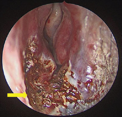 Intraoperative cavity after complete endoscopic excision of nasal mass. Arrow showing site of attachment.